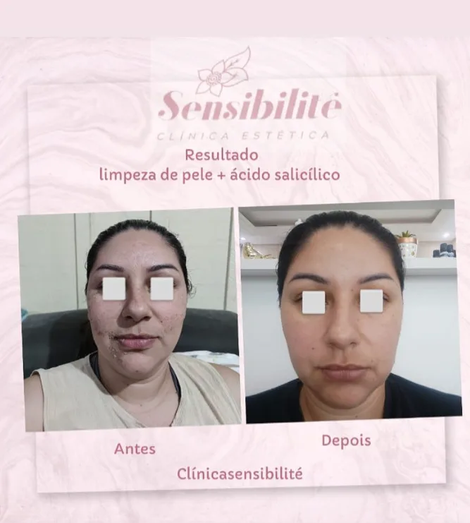 Antes e depois: limpeza de pele com ácido salicílico