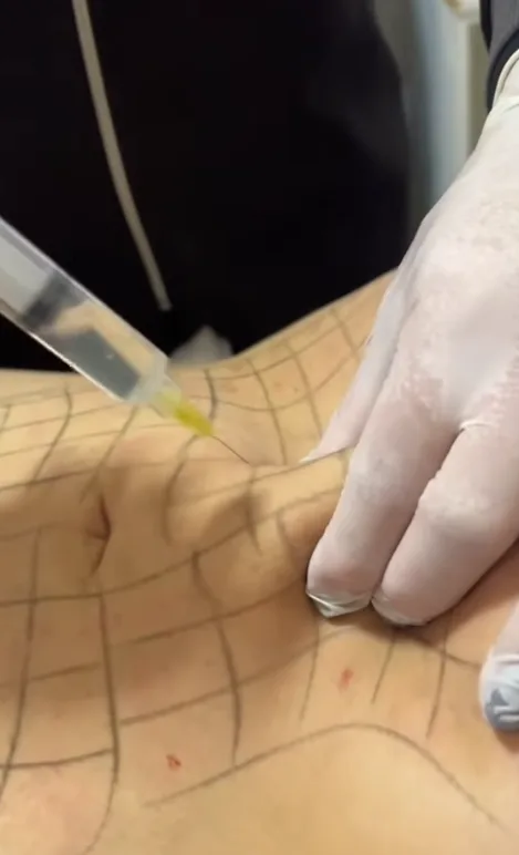 Aplicação de enzimas na região abdominal demarcada