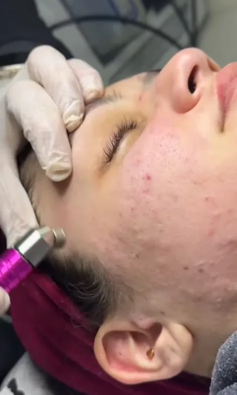 Microagulhamento facial com caneta dermatológica